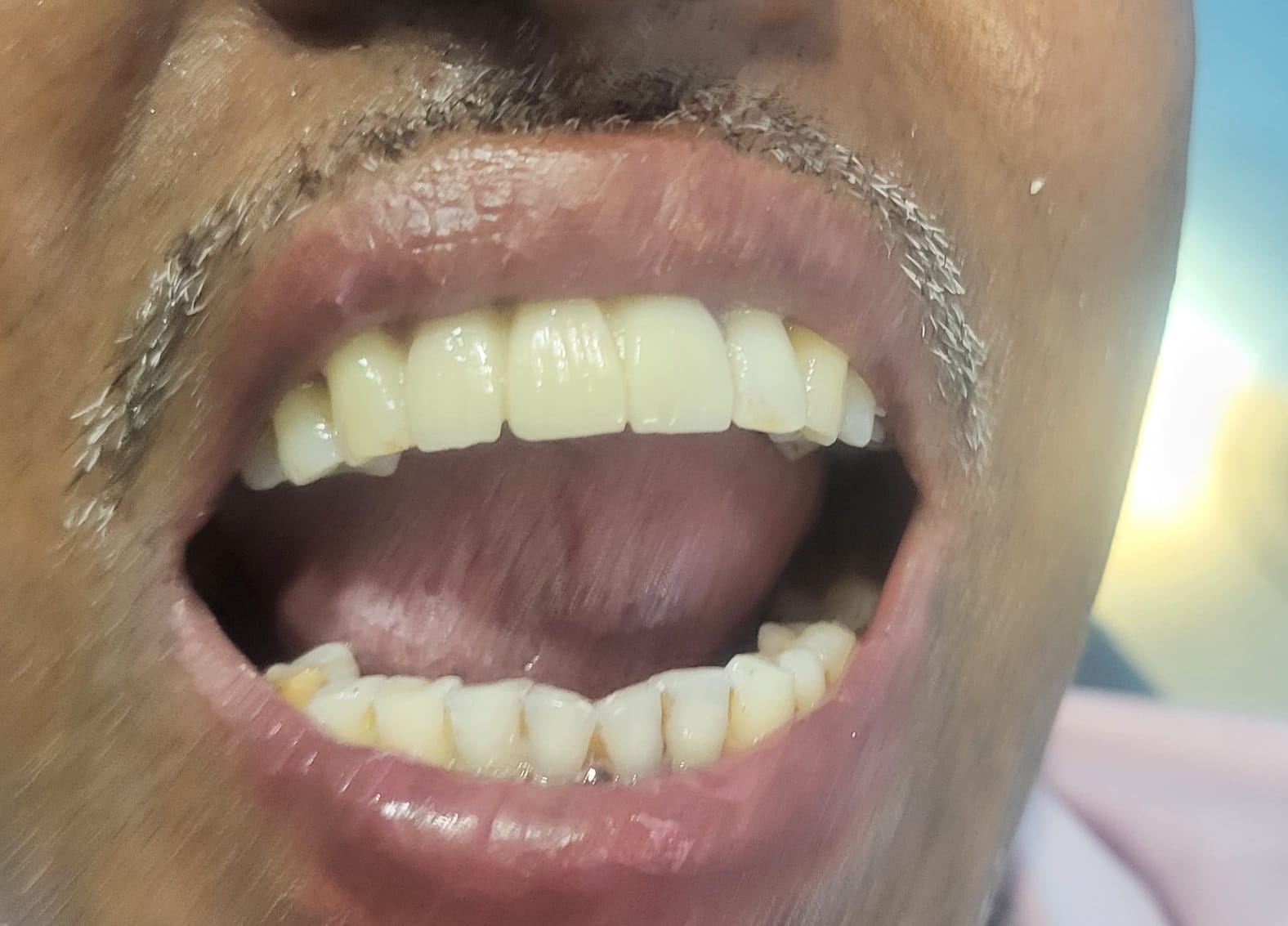 implant before in smile return dental clinic